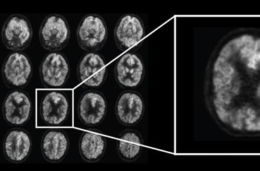 Lehet, hogy eddig rosszul tudták: nem biztos, hogy az agyban kell keresni az Alzheimer-kór okát